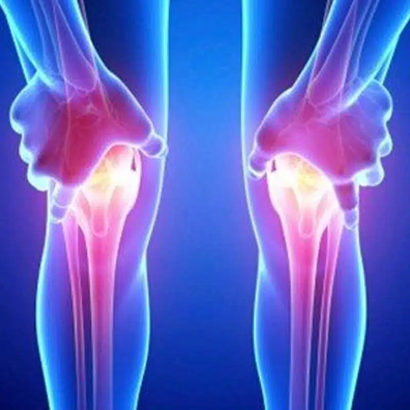 Artrosis de Rodilla