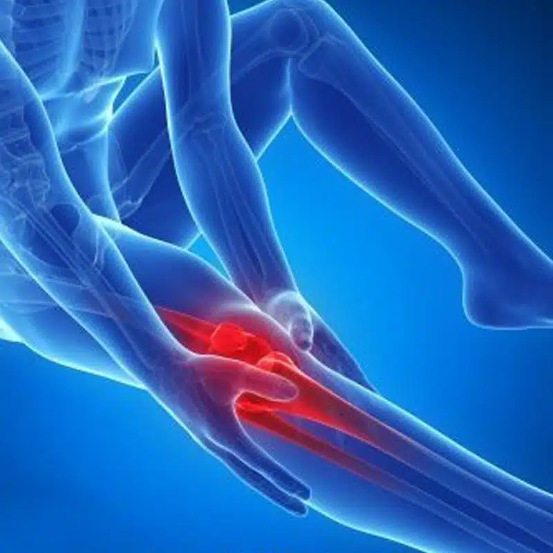 Esguince de Rodilla