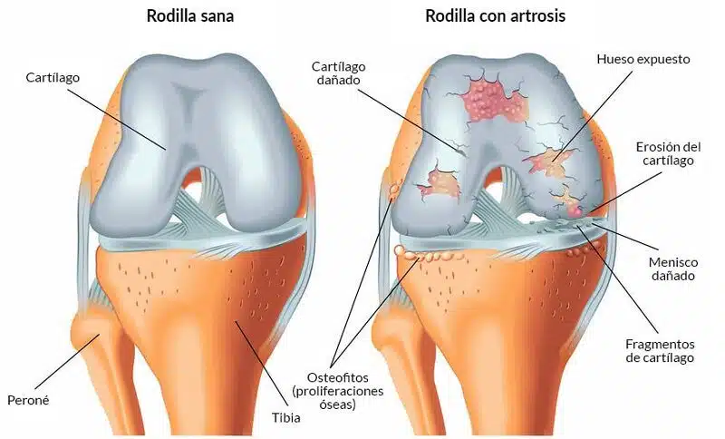Artrosis de Rodilla