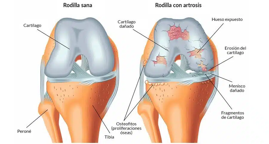 Artrosis de Rodilla