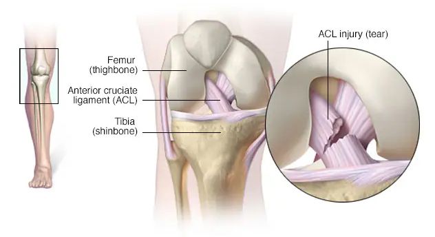 lesiones del ligamento cruzado anterior (LCA)