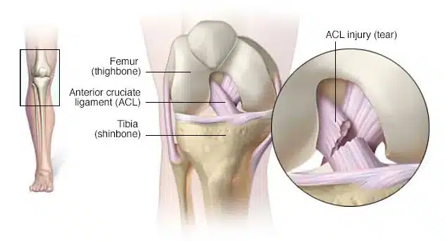 lesiones del ligamento cruzado anterior (LCA)