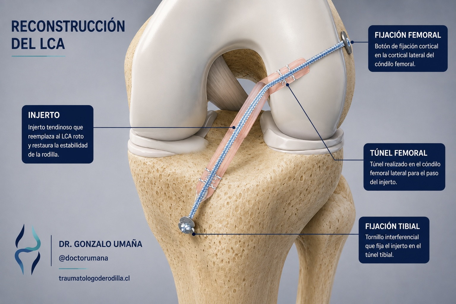 Reconstrucción del LCA con injerto tendinoso, fijación femoral, túnel femoral y fijación tibial.