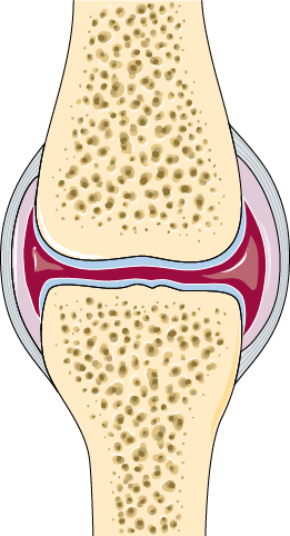 Corte de una articulación sana que muestra el cartílago articular íntegro, el espacio articular conservado y la membrana sinovial