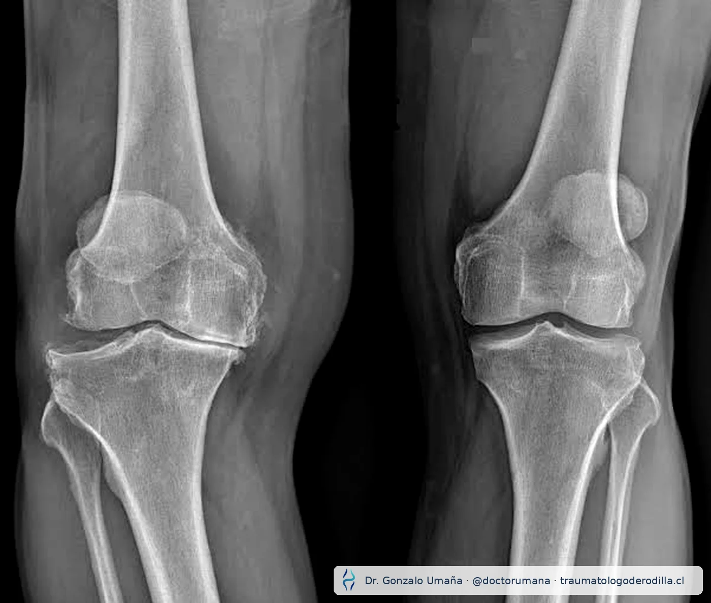 Radiografía de rodillas con estrechamiento del espacio articular y cambios degenerativos