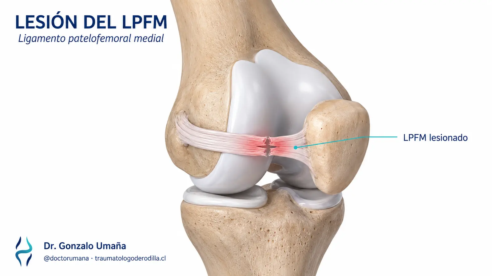 Ilustración anatómica de una lesión del ligamento patelofemoral medial entre el fémur y la rótula