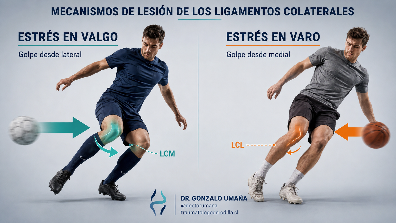 Mecanismos de lesión del LCM y LCL: estrés en valgo y varo