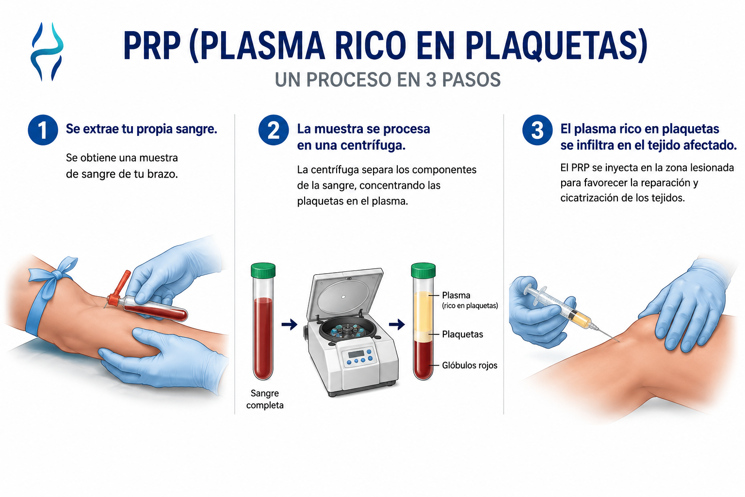 Proceso del plasma rico en plaquetas (PRP) en 3 pasos: extracción de sangre, centrifugación y aplicación