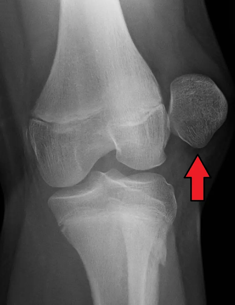 Radiografía frontal de rodilla que muestra una luxación lateral de rótula señalada con una flecha roja