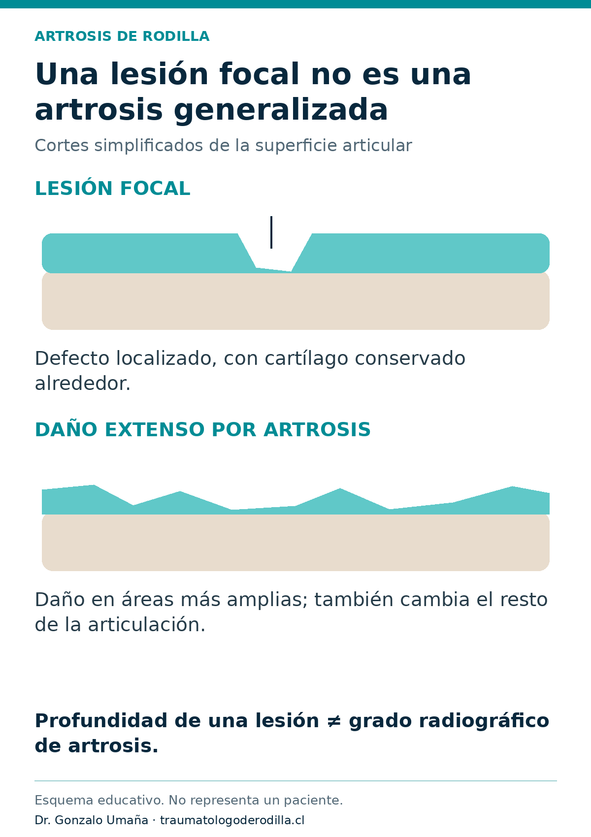 Cortes esquemáticos de cartílago y hueso: un defecto localizado con tejido conservado alrededor y un daño articular más extenso.